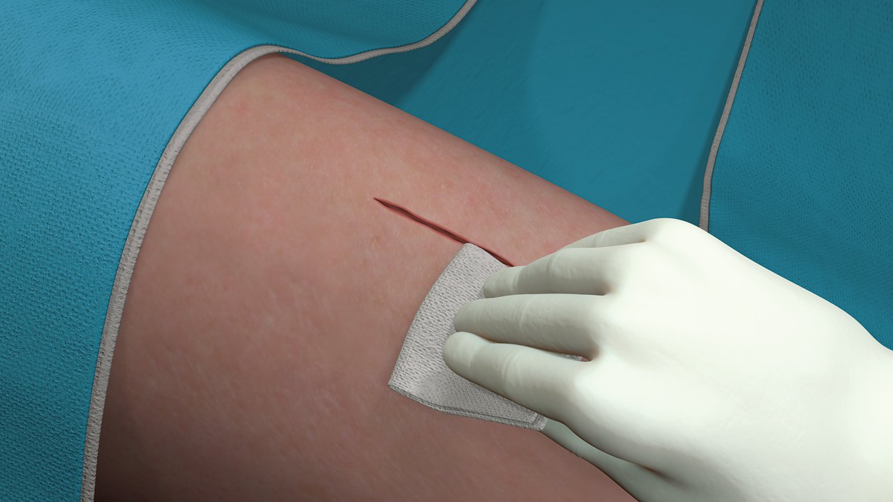 Steg 1 för applicering av Steri-Strip Adhesive Closures