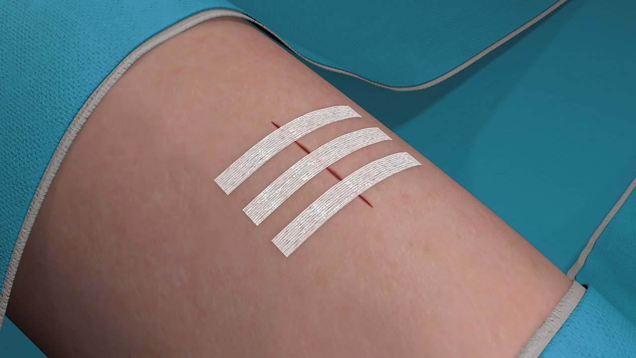 Étape 6 pour l'application des fermetures adhésives Steri-Strip