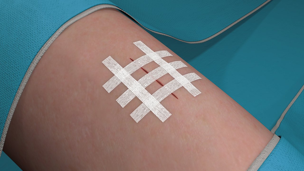 Étape 7 pour l'application des fermetures adhésives Steri-Strip