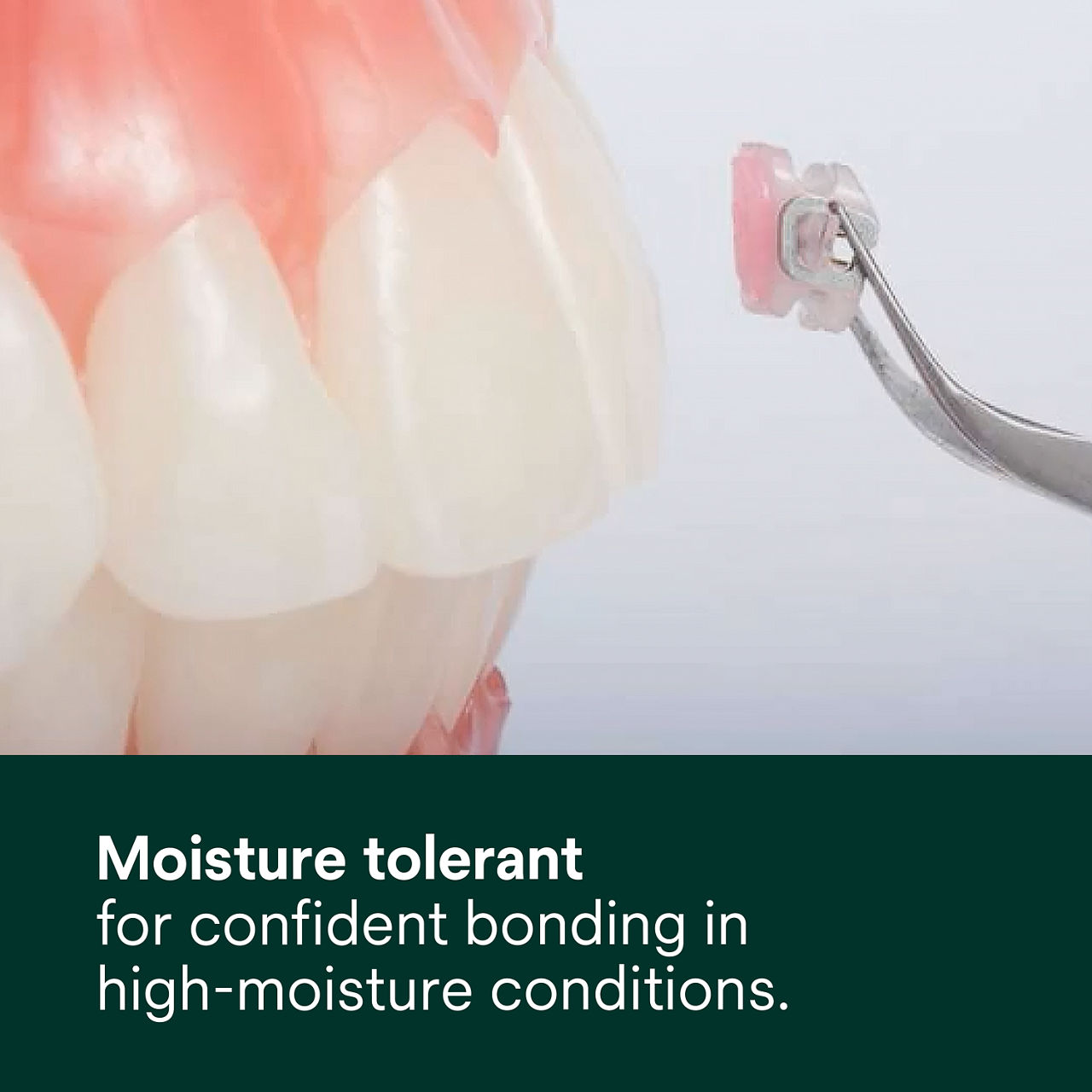 (2) Transbond Plus Color Change Adhesive: Moisture-tolerant for confident bonding