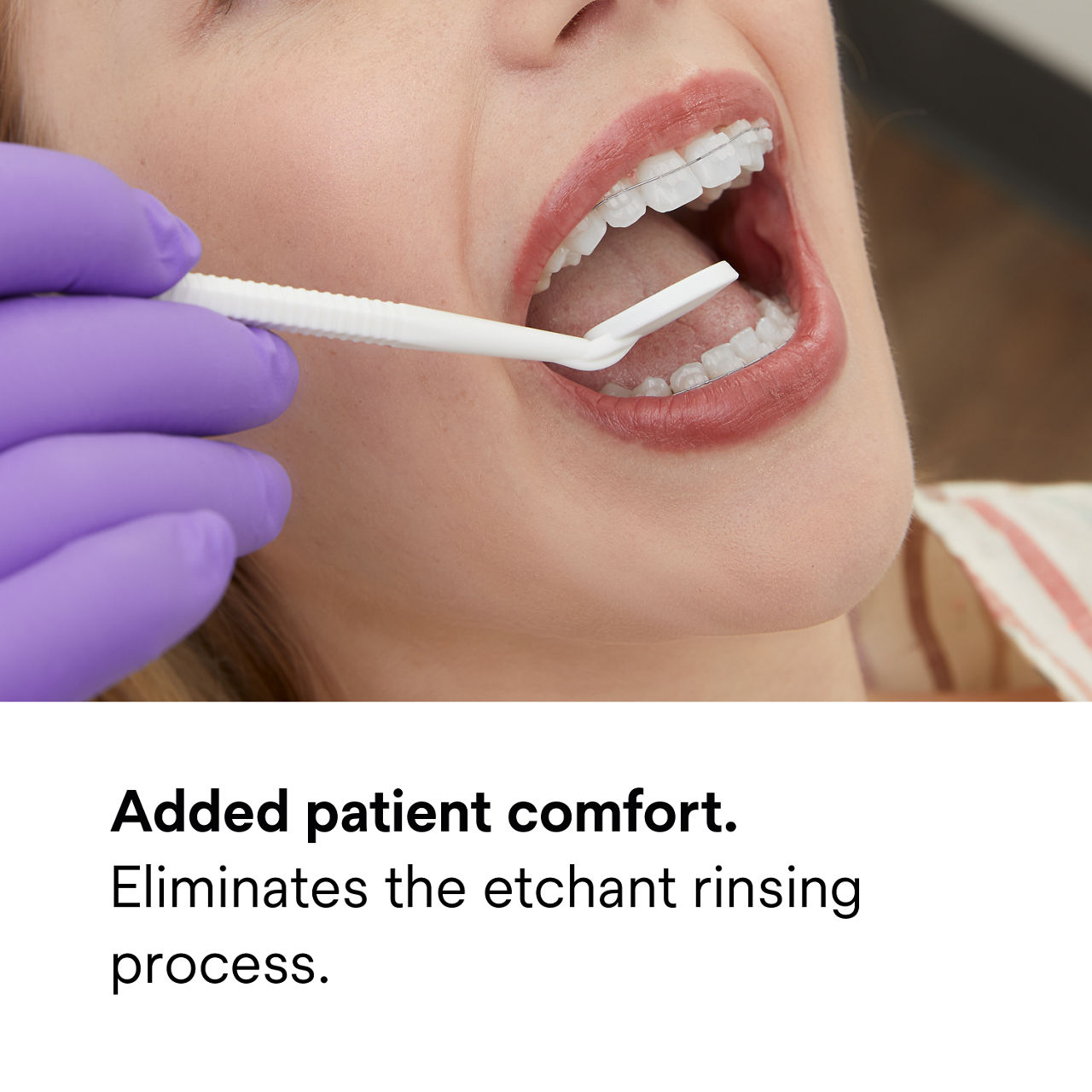 (3) Transbond Plus Self-Etching Primer: Added patient comfort by eliminating etchant rinsing