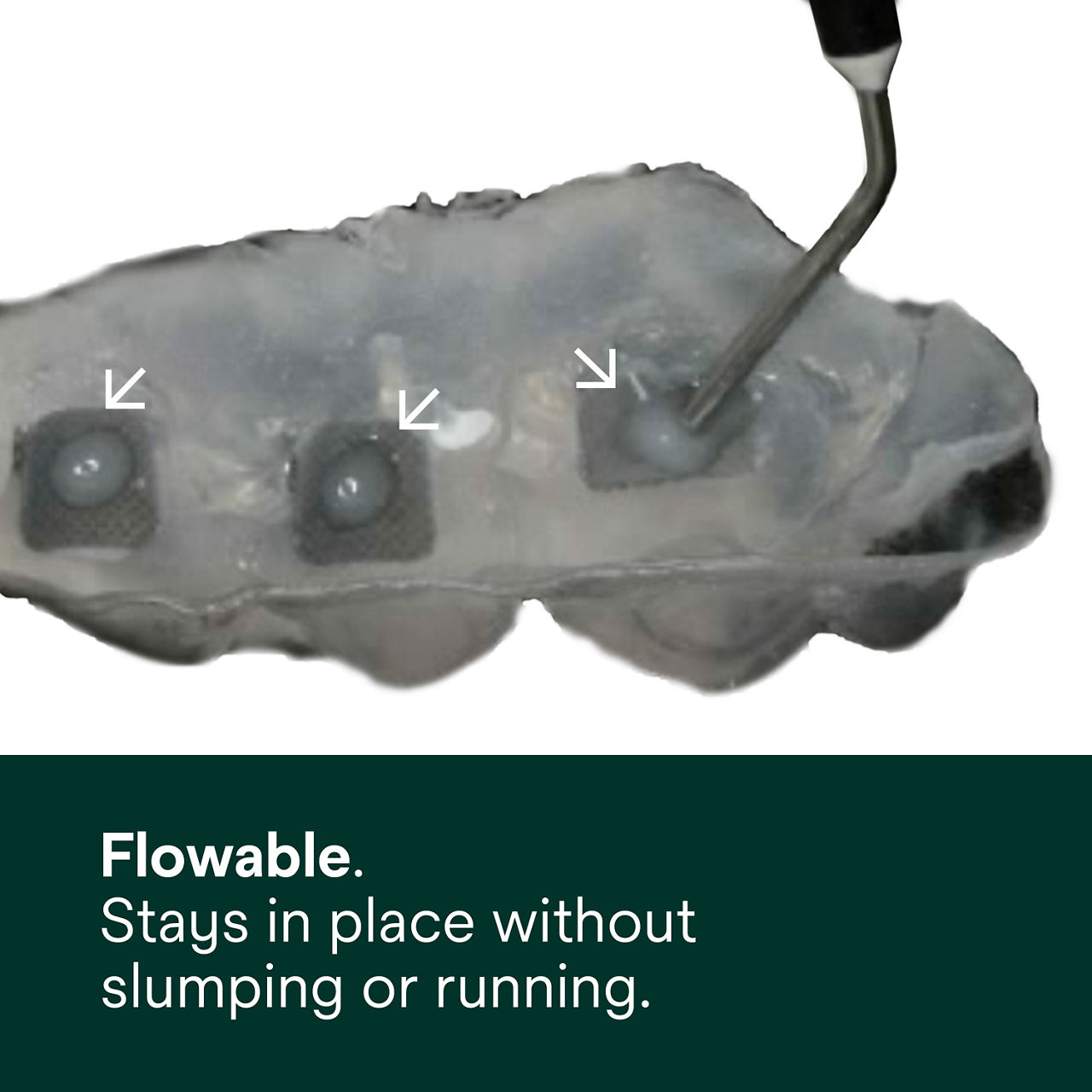 (2) Transbond Supreme LV Adhesive: Flowable. Stays in places without slumping or running