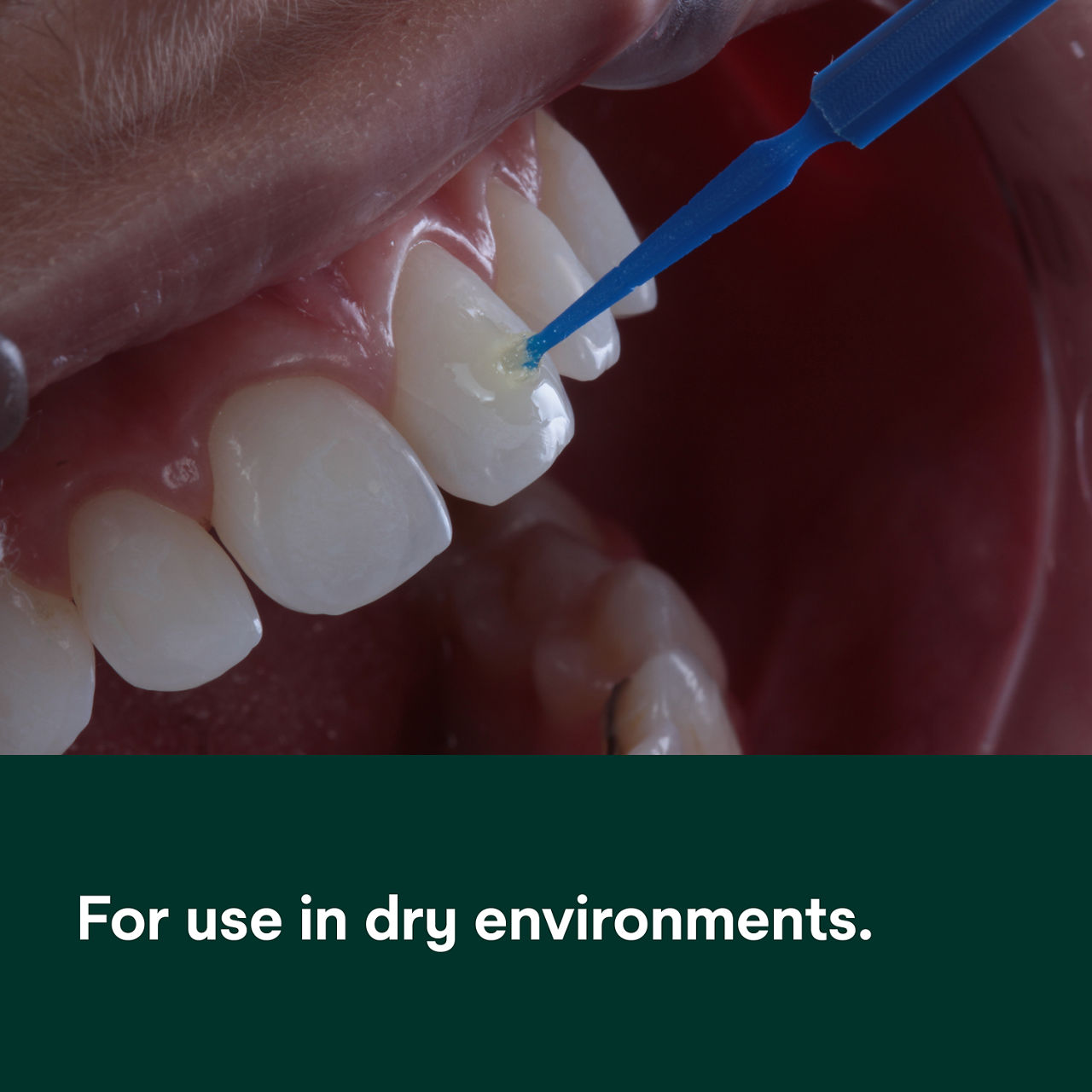 (2) Transbond XT Light Cure Adhesive Primer: for use in dry environments