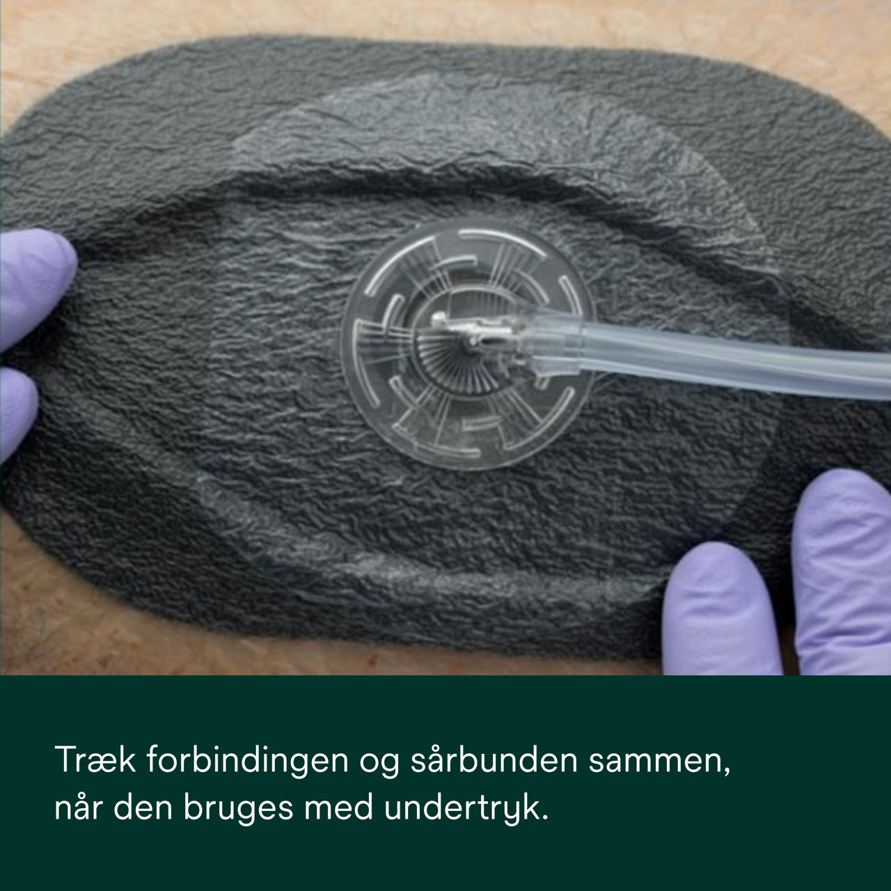 2: V.A.C. Peel and Place – Trækker bandagen og sårbunden sammen.