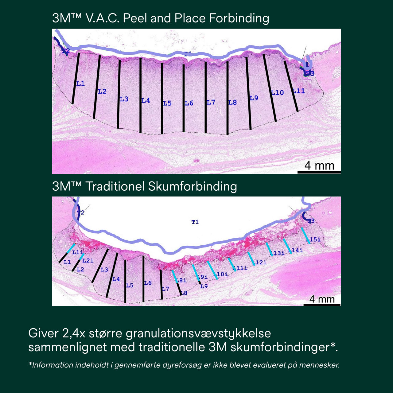 6: V.A.C. Peel and Place – Giver 2,4 gange større granulationsvævstykkelse