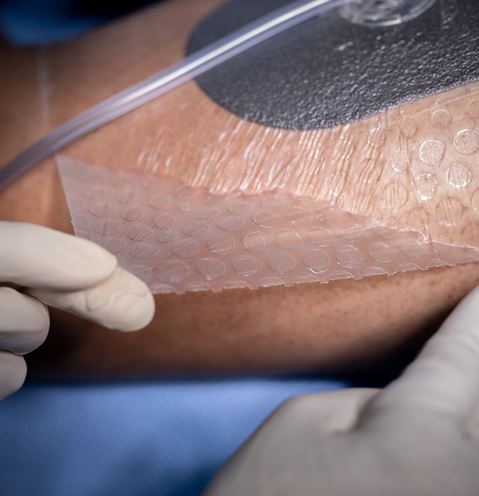 Close-up of gloved hands applying a transparent VAC Peel and Place Dressing with tubing to a patient’s skin for negative pressure wound therapy.