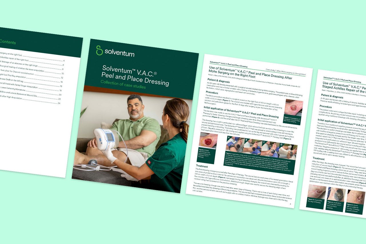 Graphic of a four-page spread showing a Solventum VAC Peel and Place Dressing case study with a cover image and detailed clinical content pages, angled on a teal background.