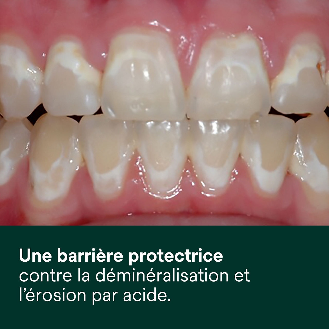 (2) Vanish XT: crée une barrière protectrice contre la déminéralisation et l'érosion acide